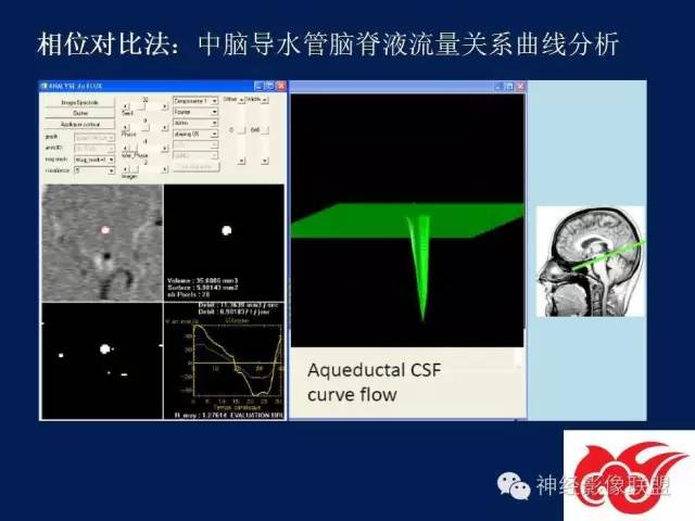 【PPT】脑脊液循环障碍