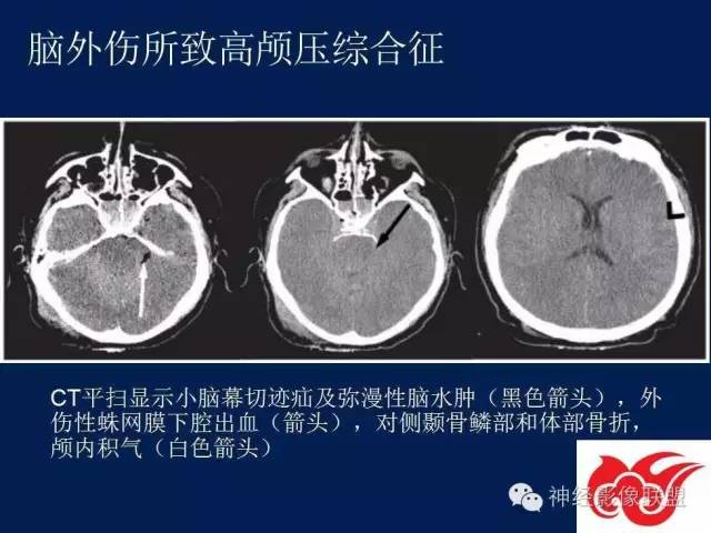 【PPT】脑脊液循环障碍