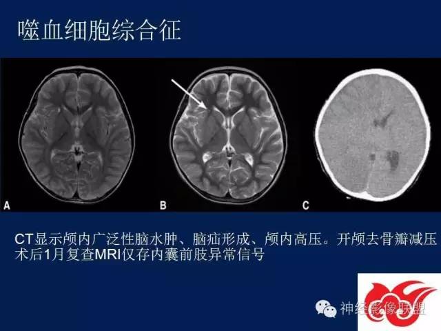【PPT】脑脊液循环障碍