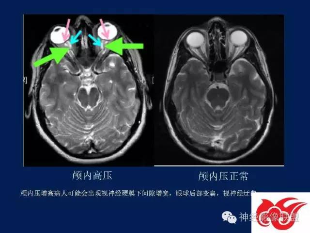 【PPT】脑脊液循环障碍