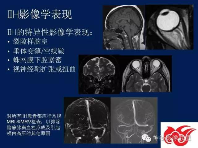 【PPT】脑脊液循环障碍