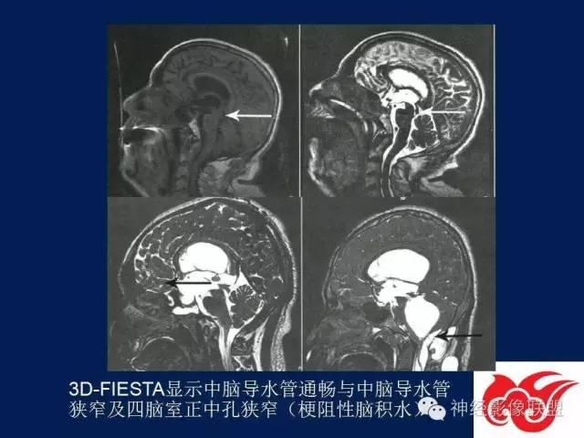 【PPT】脑脊液循环障碍
