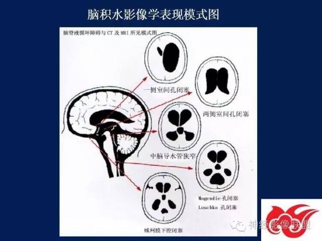 【PPT】脑脊液循环障碍