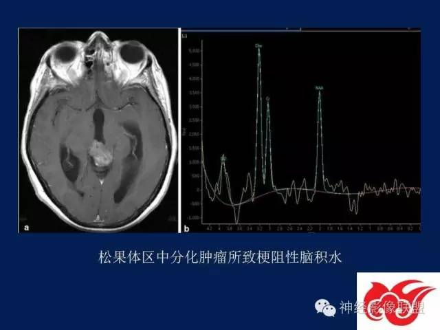 【PPT】脑脊液循环障碍