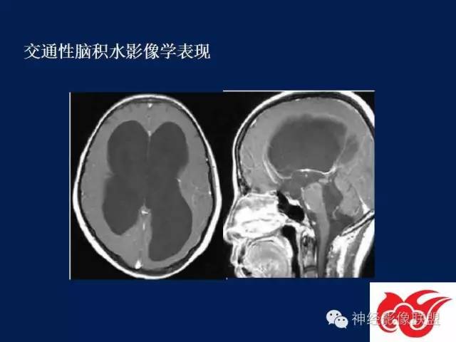 【PPT】脑脊液循环障碍