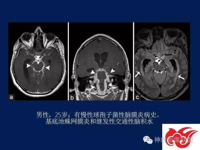 【PPT】脑脊液循环障碍