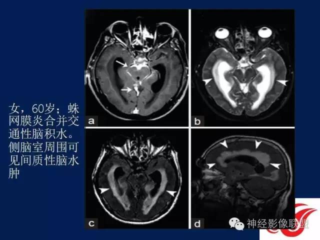 【PPT】脑脊液循环障碍