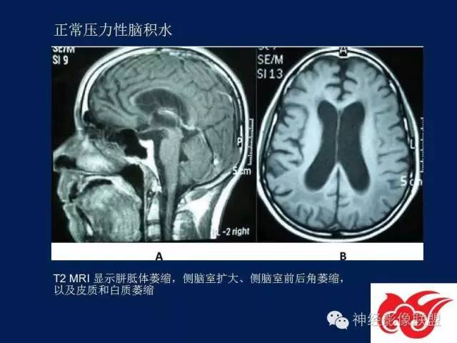 【PPT】脑脊液循环障碍