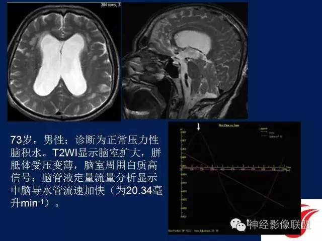 【PPT】脑脊液循环障碍