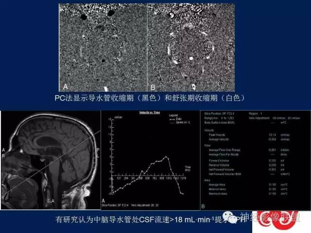 【PPT】脑脊液循环障碍