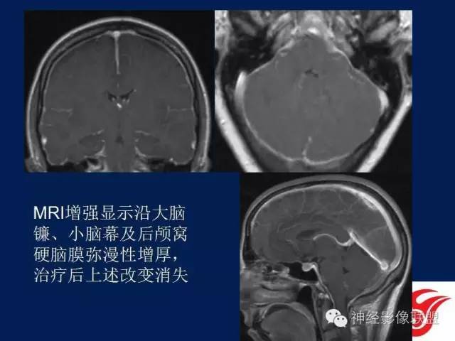 【PPT】脑脊液循环障碍