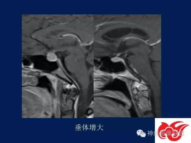 【PPT】脑脊液循环障碍