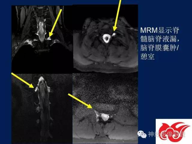 【PPT】脑脊液循环障碍