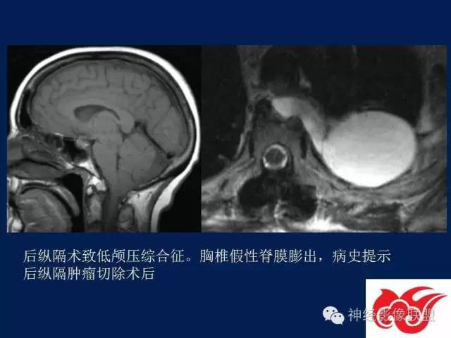 【PPT】脑脊液循环障碍