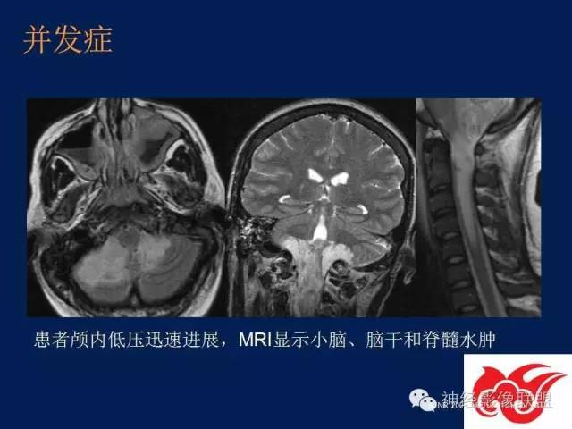 【PPT】脑脊液循环障碍