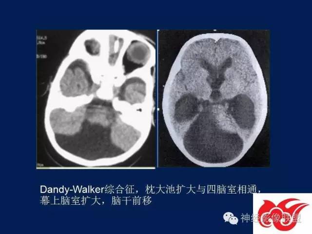 【PPT】脑脊液循环障碍