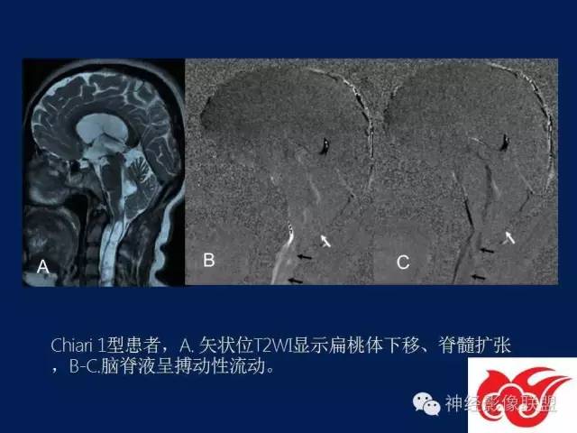 【PPT】脑脊液循环障碍