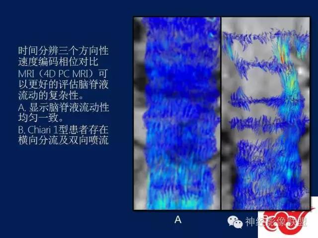 【PPT】脑脊液循环障碍