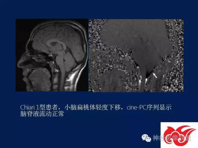 【PPT】脑脊液循环障碍