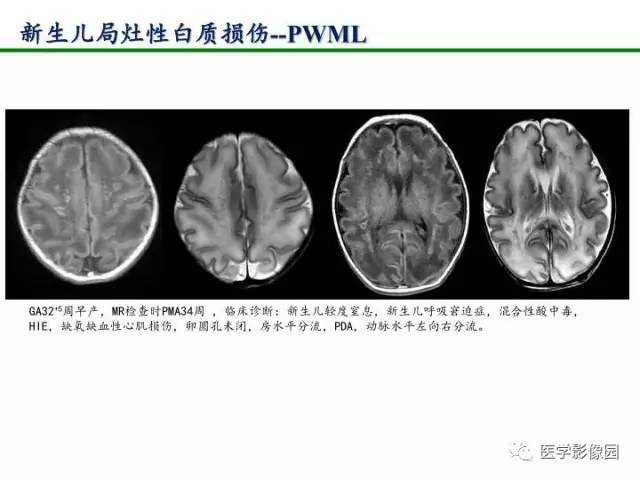 【PPT】新生儿局灶性白质损伤的MRI