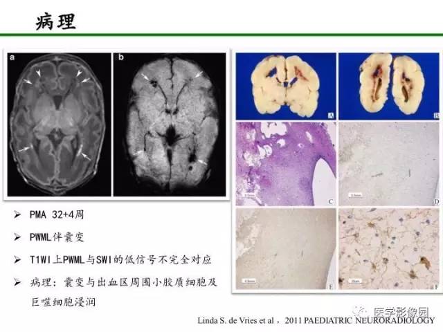【PPT】新生儿局灶性白质损伤的MRI