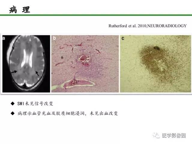 【PPT】新生儿局灶性白质损伤的MRI