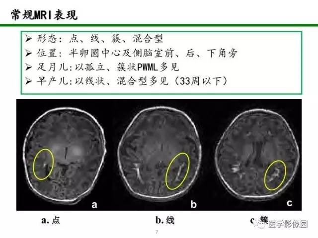 【PPT】新生儿局灶性白质损伤的MRI