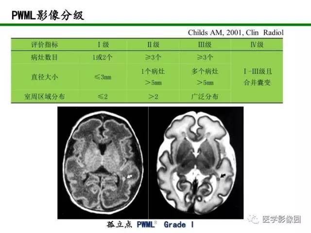 【PPT】新生儿局灶性白质损伤的MRI