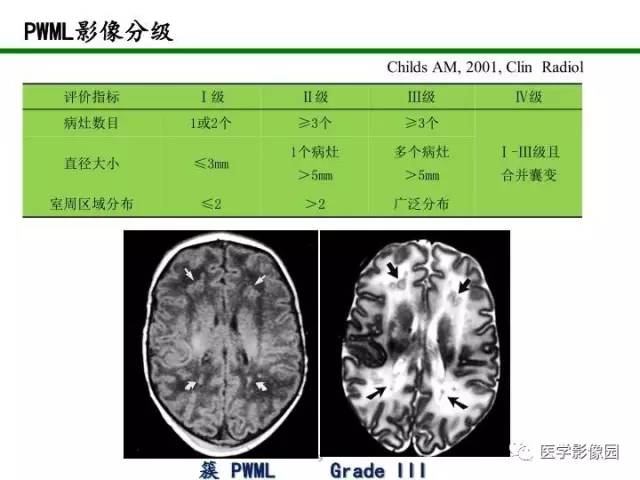 【PPT】新生儿局灶性白质损伤的MRI