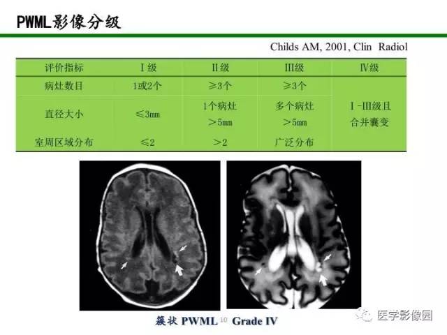 【PPT】新生儿局灶性白质损伤的MRI