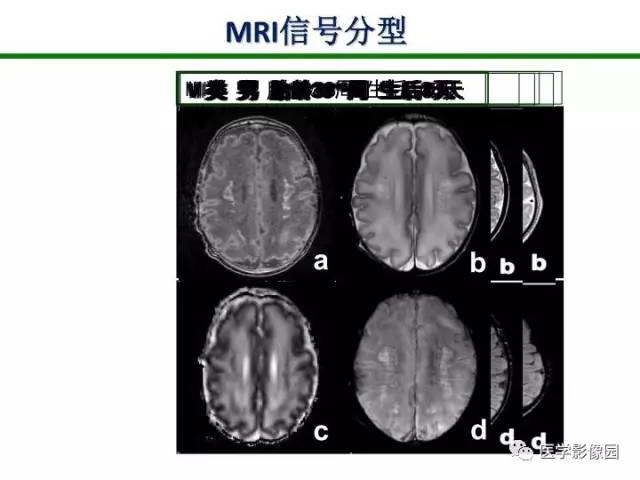 【PPT】新生儿局灶性白质损伤的MRI