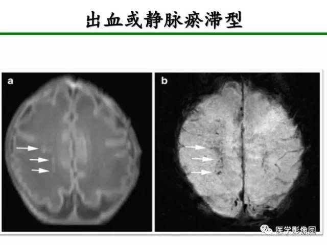 【PPT】新生儿局灶性白质损伤的MRI