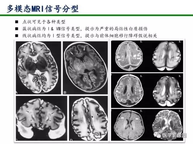 【PPT】新生儿局灶性白质损伤的MRI