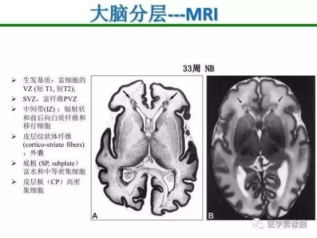 【PPT】新生儿局灶性白质损伤的MRI