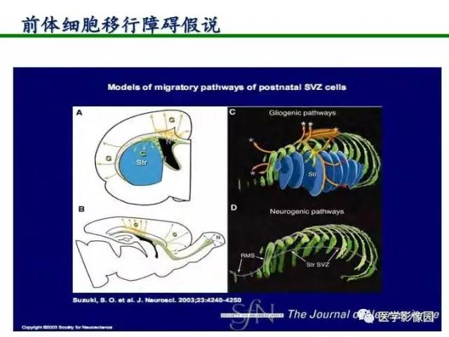 【PPT】新生儿局灶性白质损伤的MRI