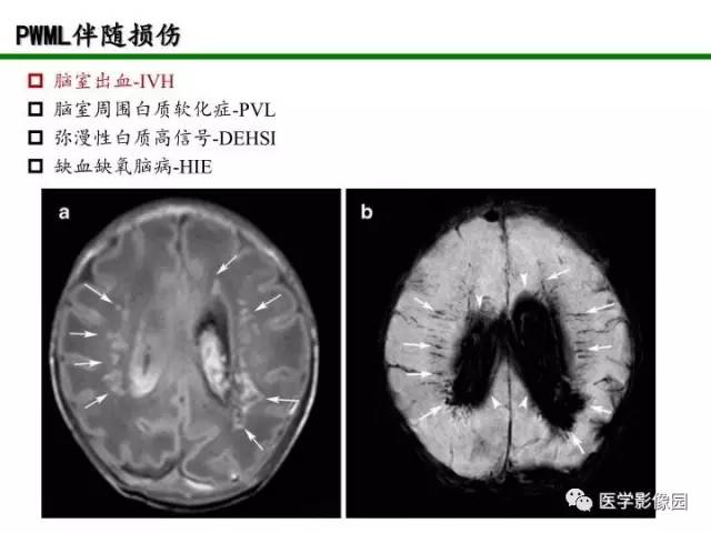 【PPT】新生儿局灶性白质损伤的MRI