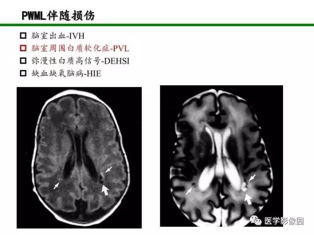 【PPT】新生儿局灶性白质损伤的MRI