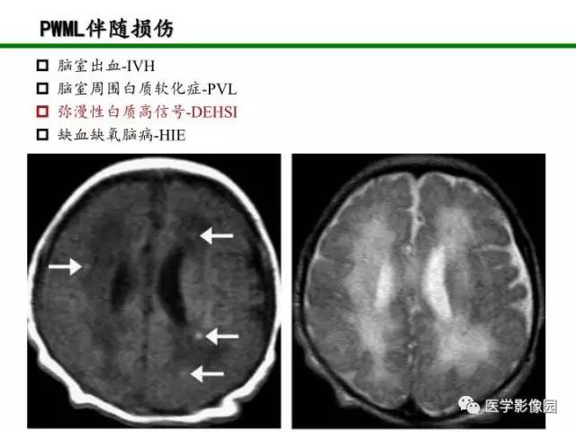 【PPT】新生儿局灶性白质损伤的MRI