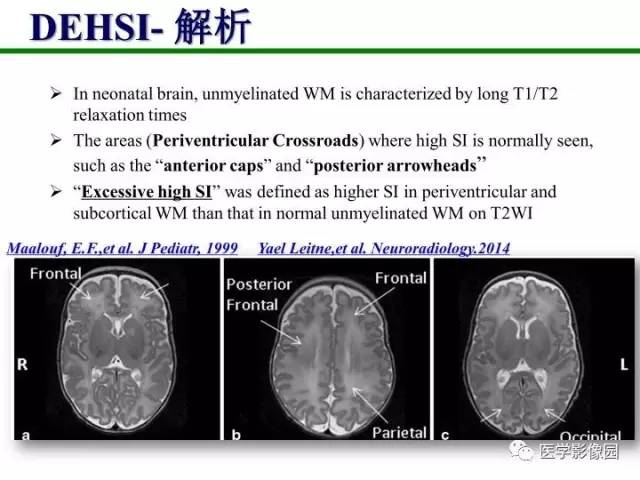 【PPT】新生儿局灶性白质损伤的MRI