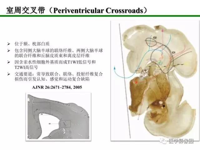 【PPT】新生儿局灶性白质损伤的MRI