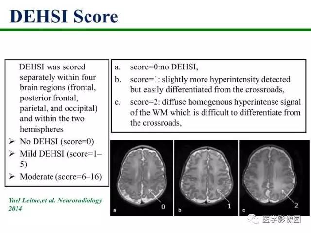 【PPT】新生儿局灶性白质损伤的MRI
