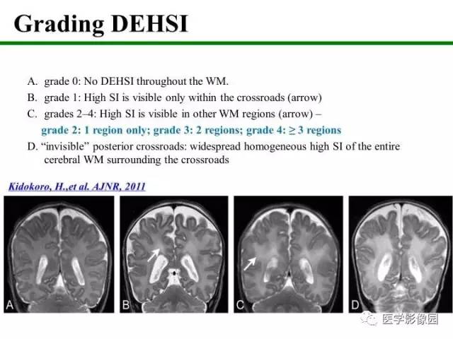 【PPT】新生儿局灶性白质损伤的MRI