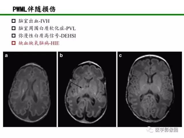 【PPT】新生儿局灶性白质损伤的MRI