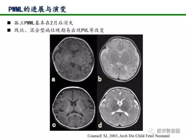 【PPT】新生儿局灶性白质损伤的MRI