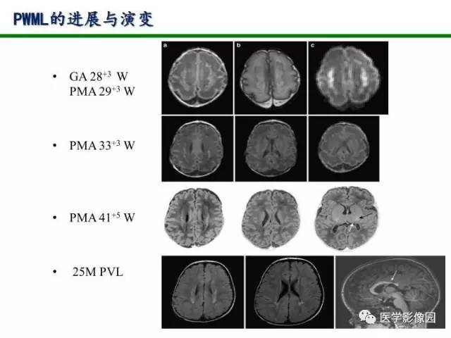 【PPT】新生儿局灶性白质损伤的MRI