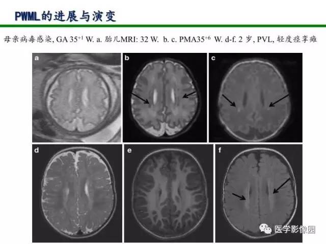 【PPT】新生儿局灶性白质损伤的MRI