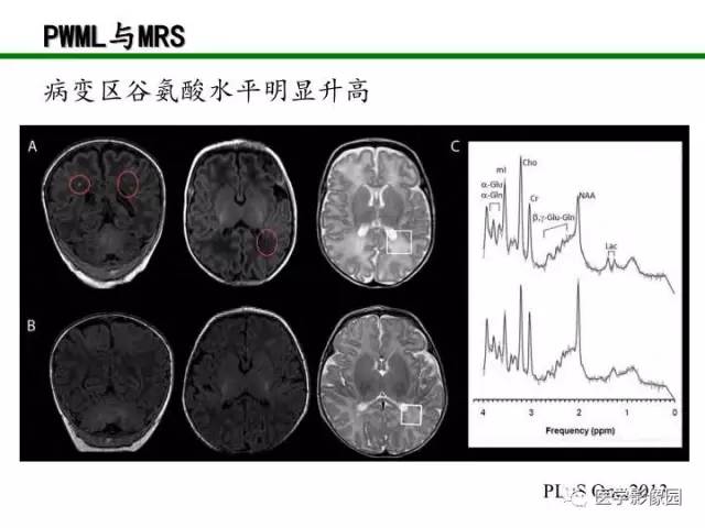 【PPT】新生儿局灶性白质损伤的MRI