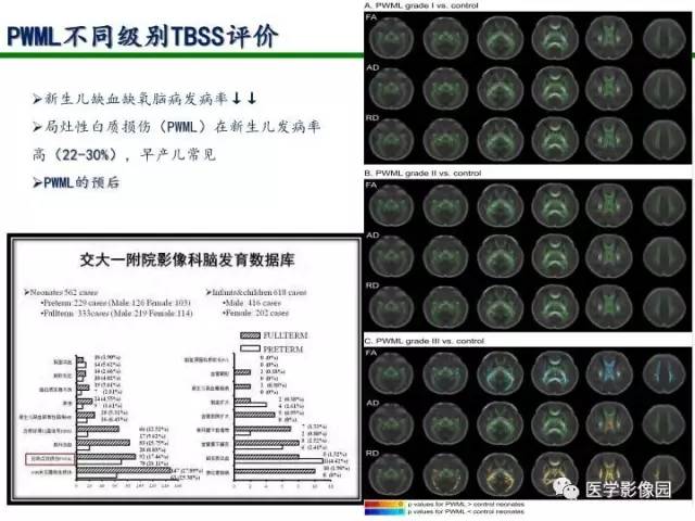 【PPT】新生儿局灶性白质损伤的MRI