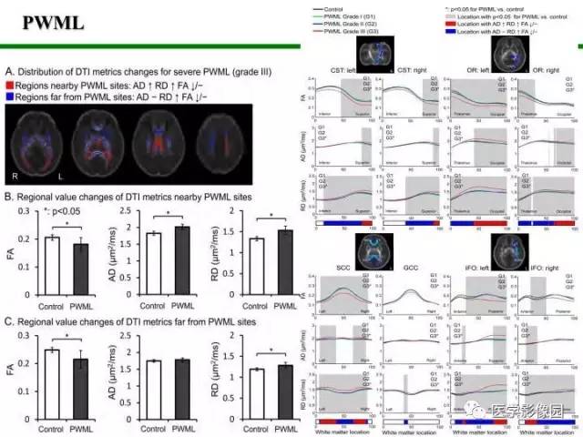 【PPT】新生儿局灶性白质损伤的MRI