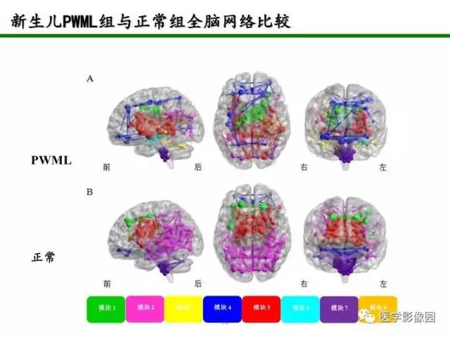 【PPT】新生儿局灶性白质损伤的MRI